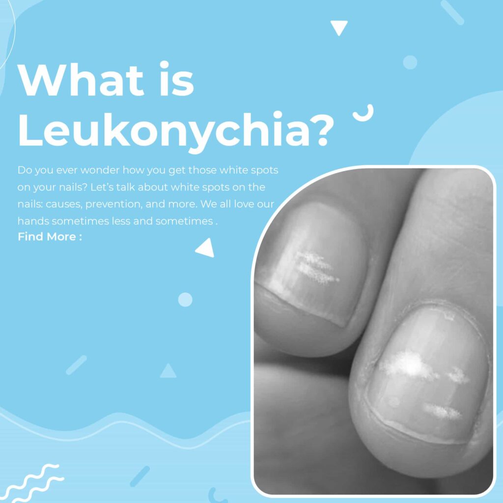 What is Leukonychia